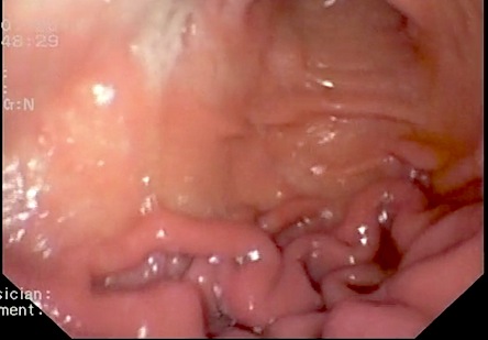 Болезнь Менетрие