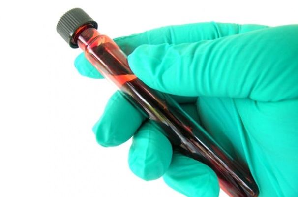 Хронический лимфоцитарный лейкоз