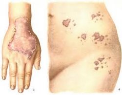 Себорейный кератоз: признаки, виды, диагностика