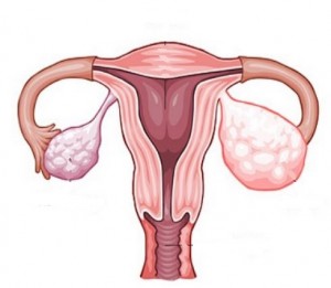 Тератома яичника