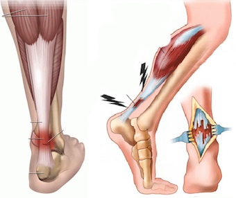 Тендинит ахиллова сухожилия