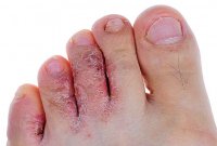 Скажите «стоп!» грибку стоп