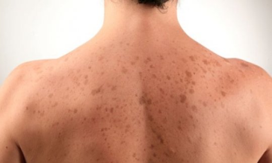 Разноцветный лишай или что за болезнь скрывается за красивым названием?