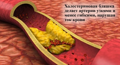 Гиперхолестеринемия