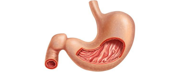 Болезнь Менетрие