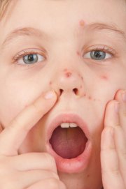 Заболевания кожи у детей