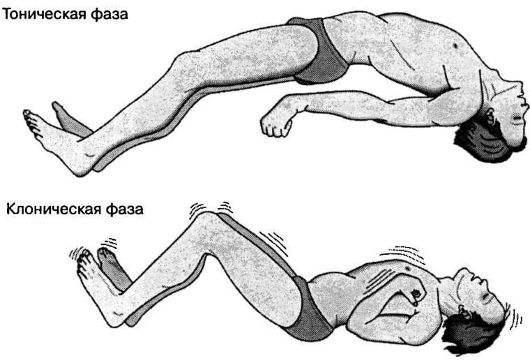 Мышечные судороги