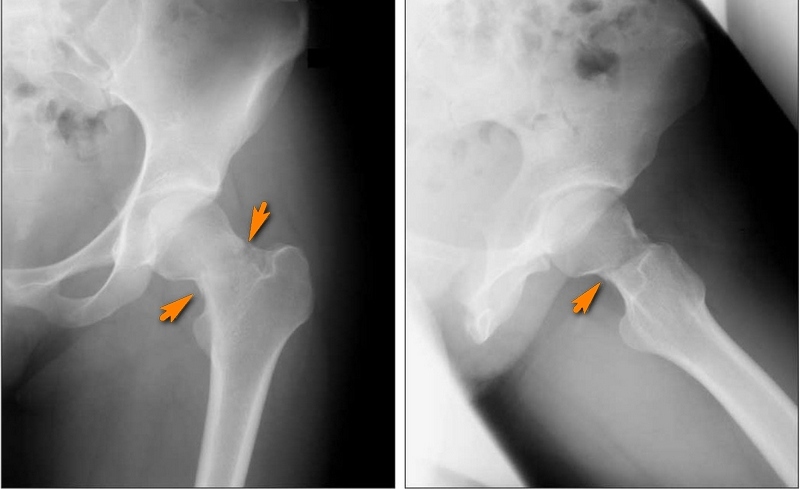Перелом бедренной кости