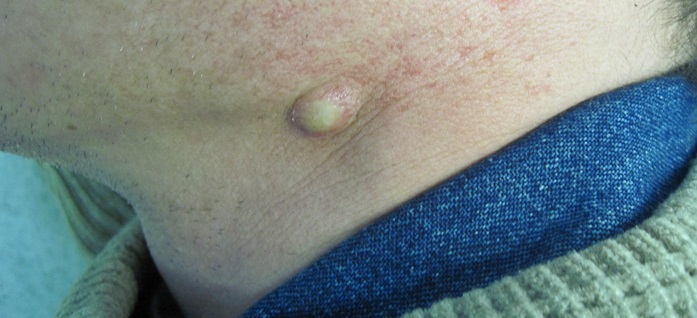 Эпидермальная киста (атерома)