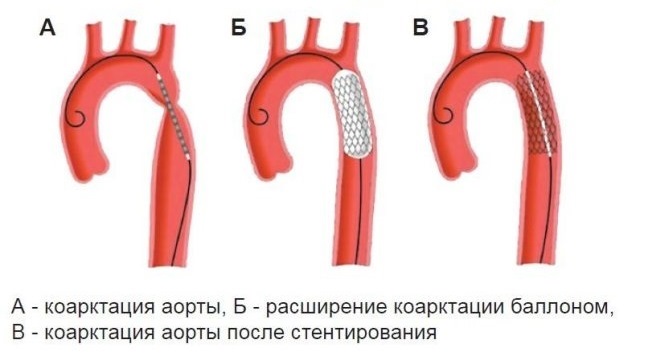 Коарктация аорты