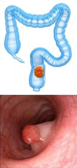 Рак прямой кишки
