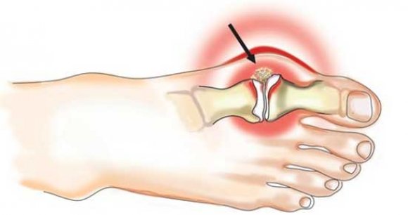 Правила жизни с подагрой. Первая помощь при приступе