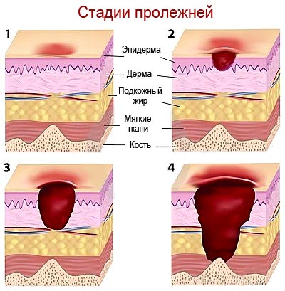 Пролежни