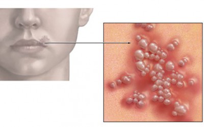 Герпес может быть причиной СХУ
