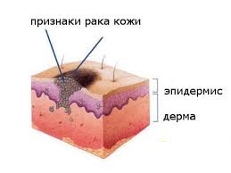 Карцинома кожи