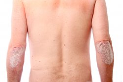 Лечение заболеваний кожи