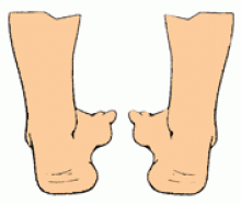 Варусная стопа