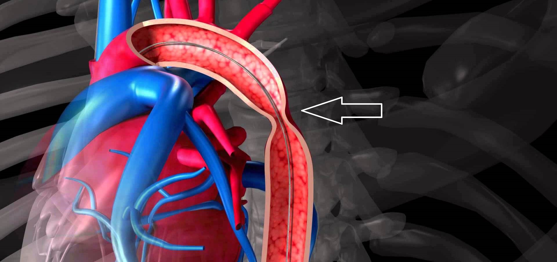 Коарктация аорты