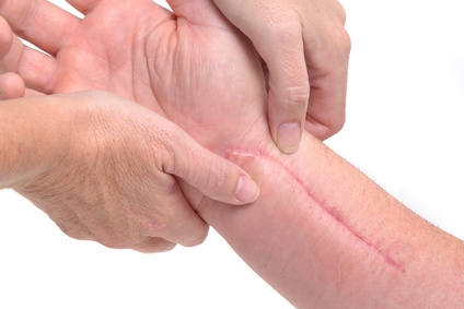 Келоидный рубец