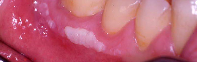 Лейкоплакия полости рта