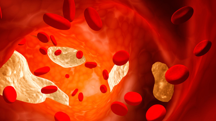 Гиперлипидемия