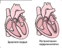 Рестриктивная кардиомиопатия