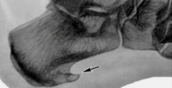 Шпора пяточная