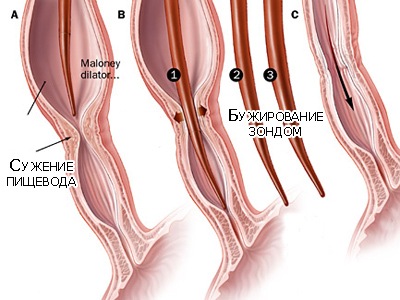Непроходимость пищевода (стриктура пищевода)
