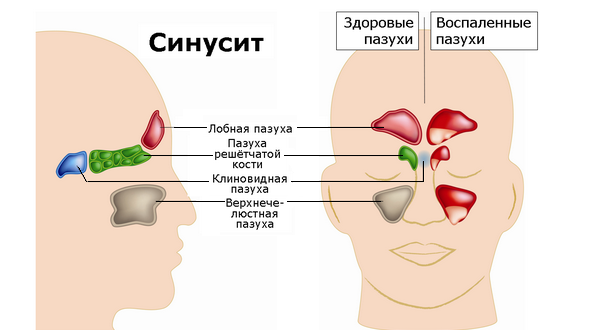 Острый синусит