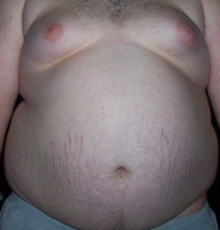 Гипоталамический синдром