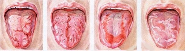 Воспаление языка (глоссит)