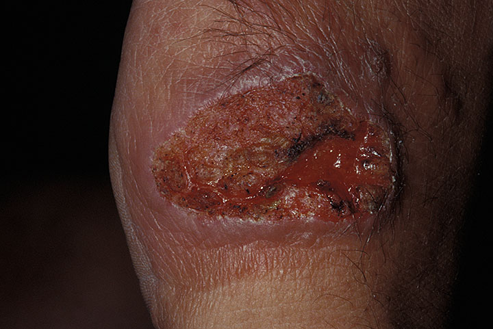 Кожный лейшманиоз