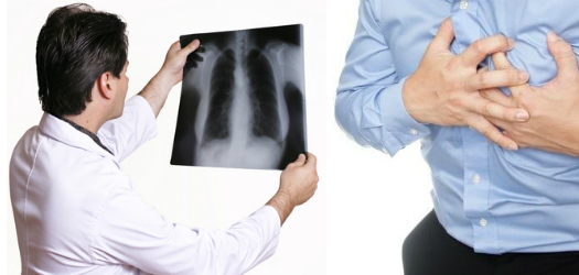 Бронхоэктатическая болезнь