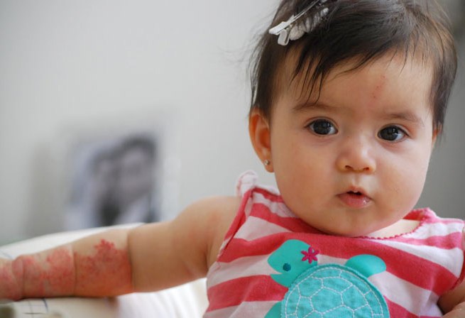 Гемангиома