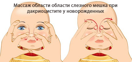 Дакриоцистит новорожденных