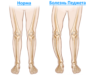 Болезнь Педжета