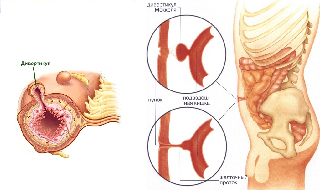 Меккелев дивертикул