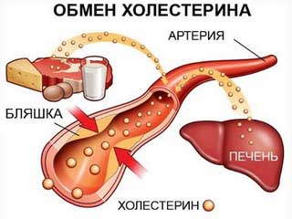 Гиперхолестеринемия