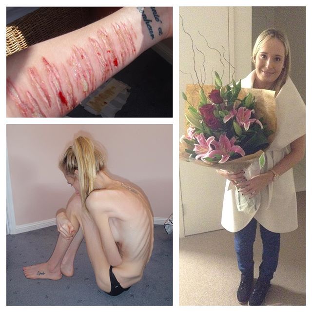 Девушка, которая весила 28 кг, показала свои фото в период анорексии