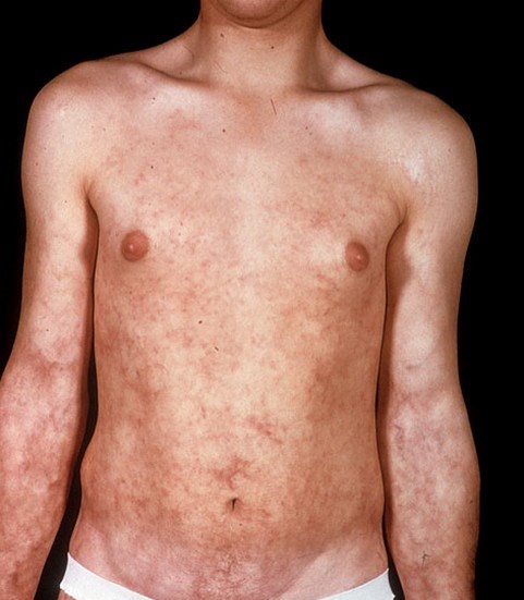 Узелковый полиартериит