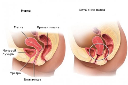 Частое мочеиспускание у женщин
