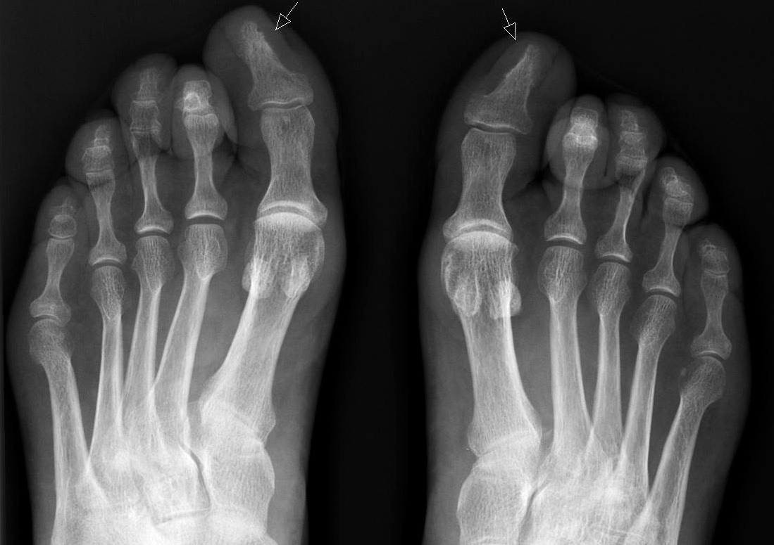 Вросший ноготь