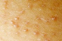 Себорейный кератоз: признаки, виды, диагностика