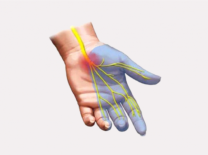 Синдром запястного канала картинки
