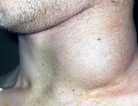 Неходжкинская лимфома