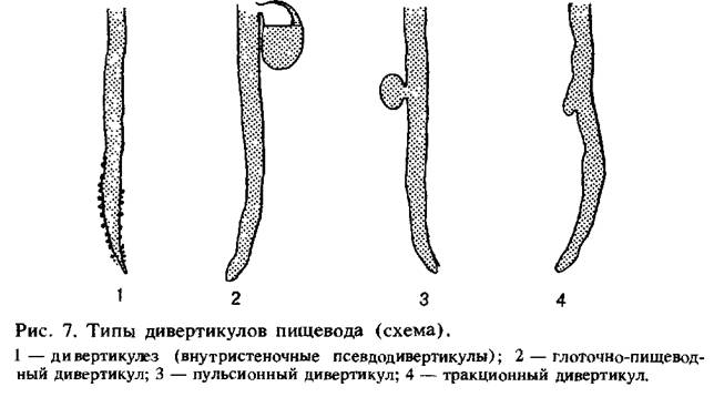 Дивертикул пищевода