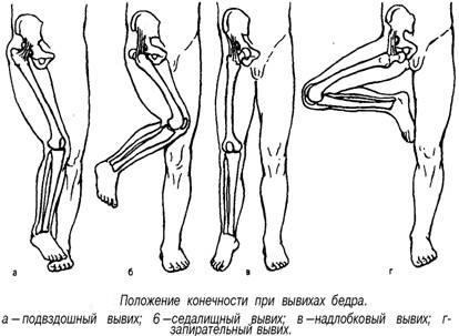 Вывих бедра
