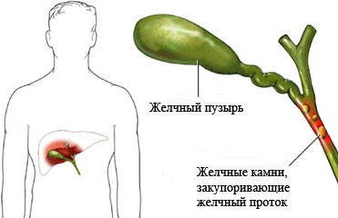 Острый холецистит