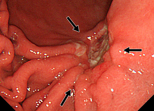 Язва двенадцатиперстной кишки