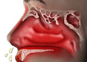 Хронический ринит